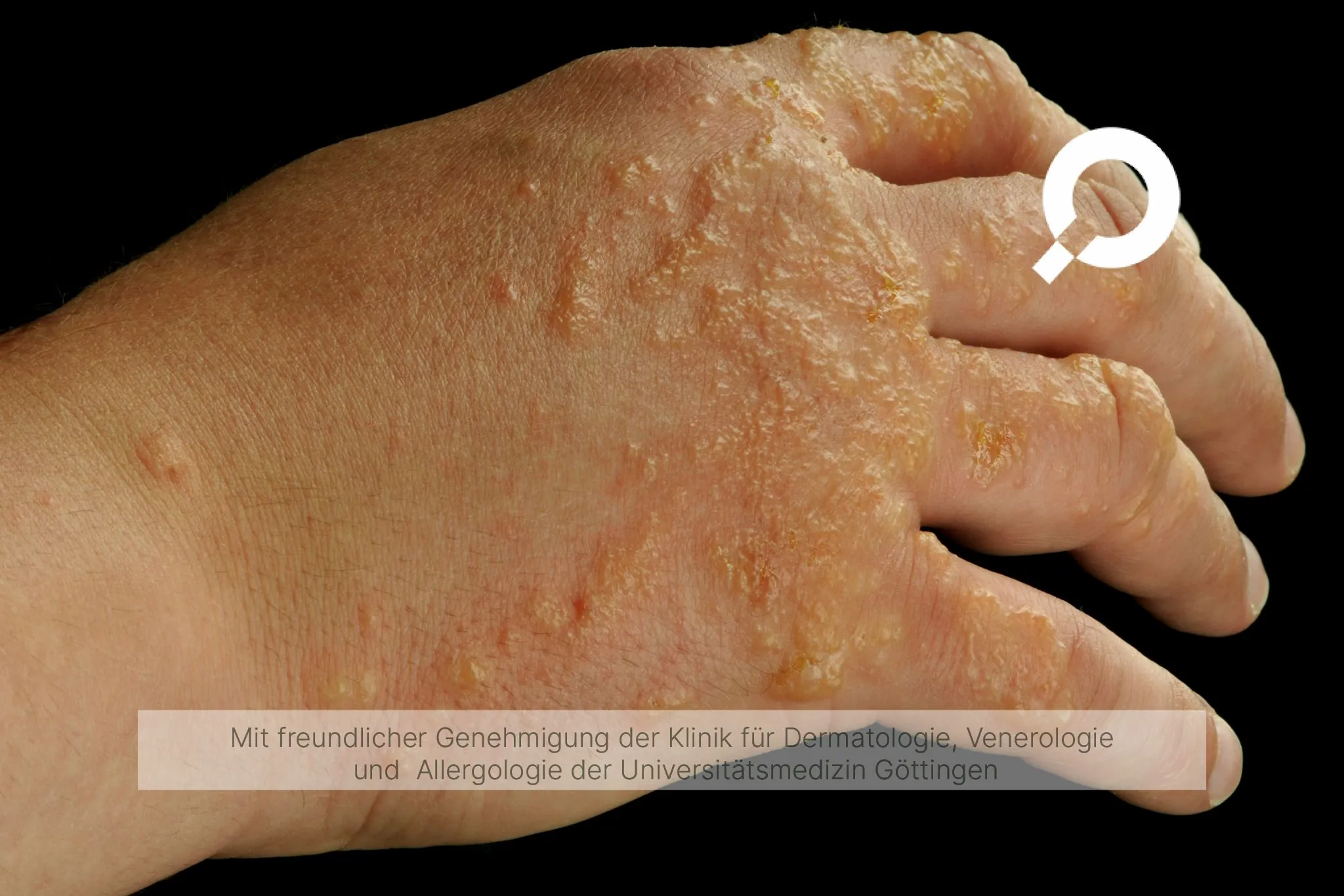 Hautausschlag an der Hand
