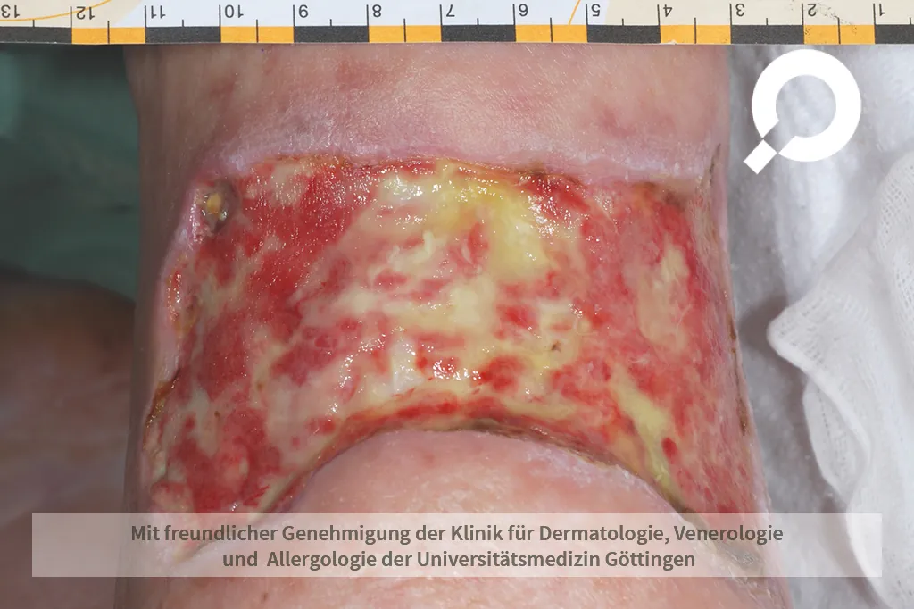Beispielbild Symptome Ulcus cruris