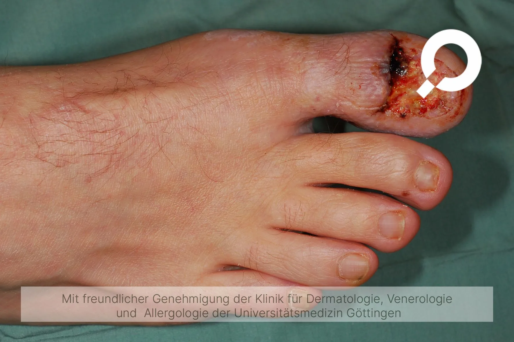 Beispielbild Symptome eingewachsener Zehnagel