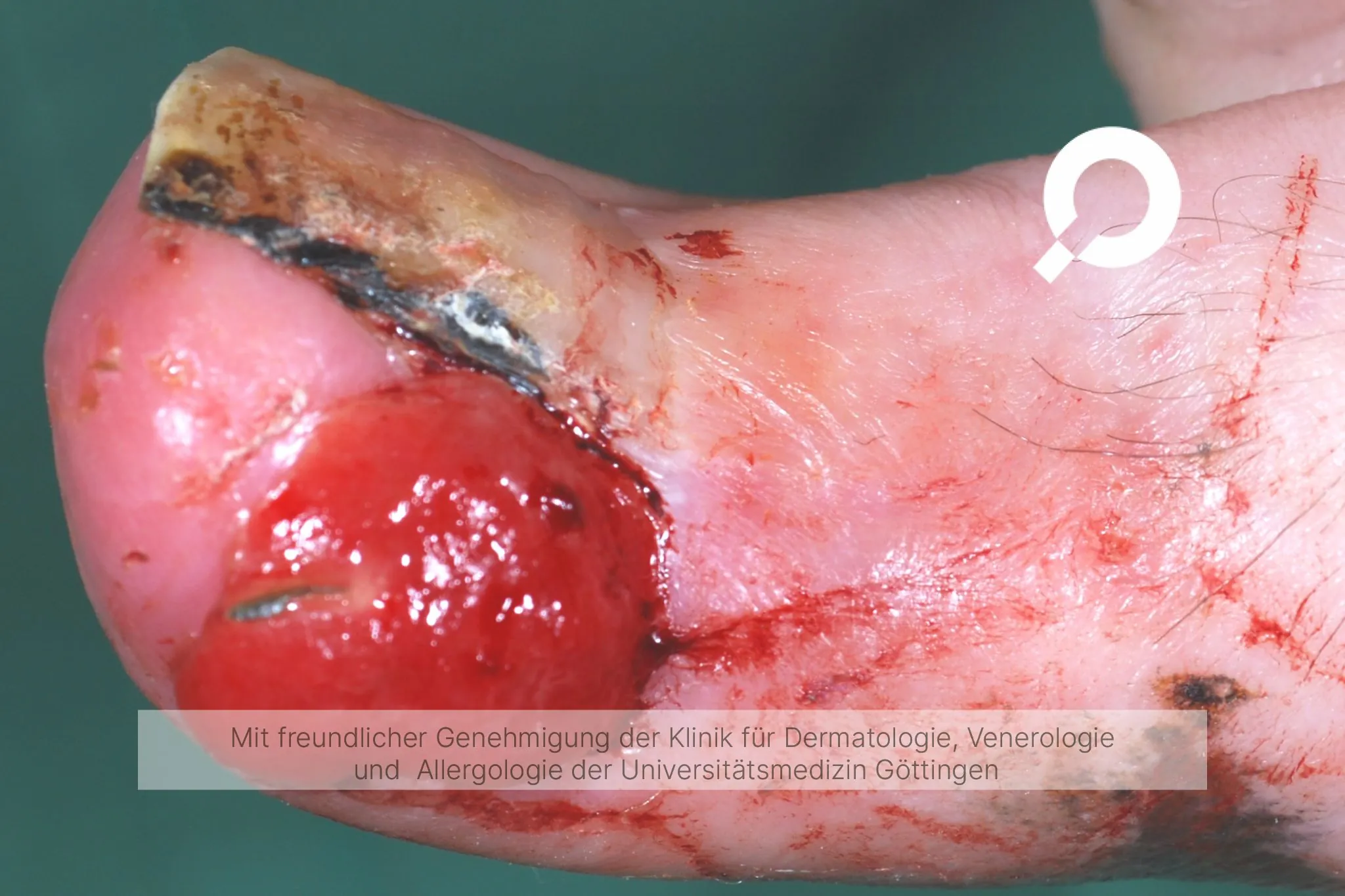 Beispielbilder Symptome eingewachsener Zehennagel