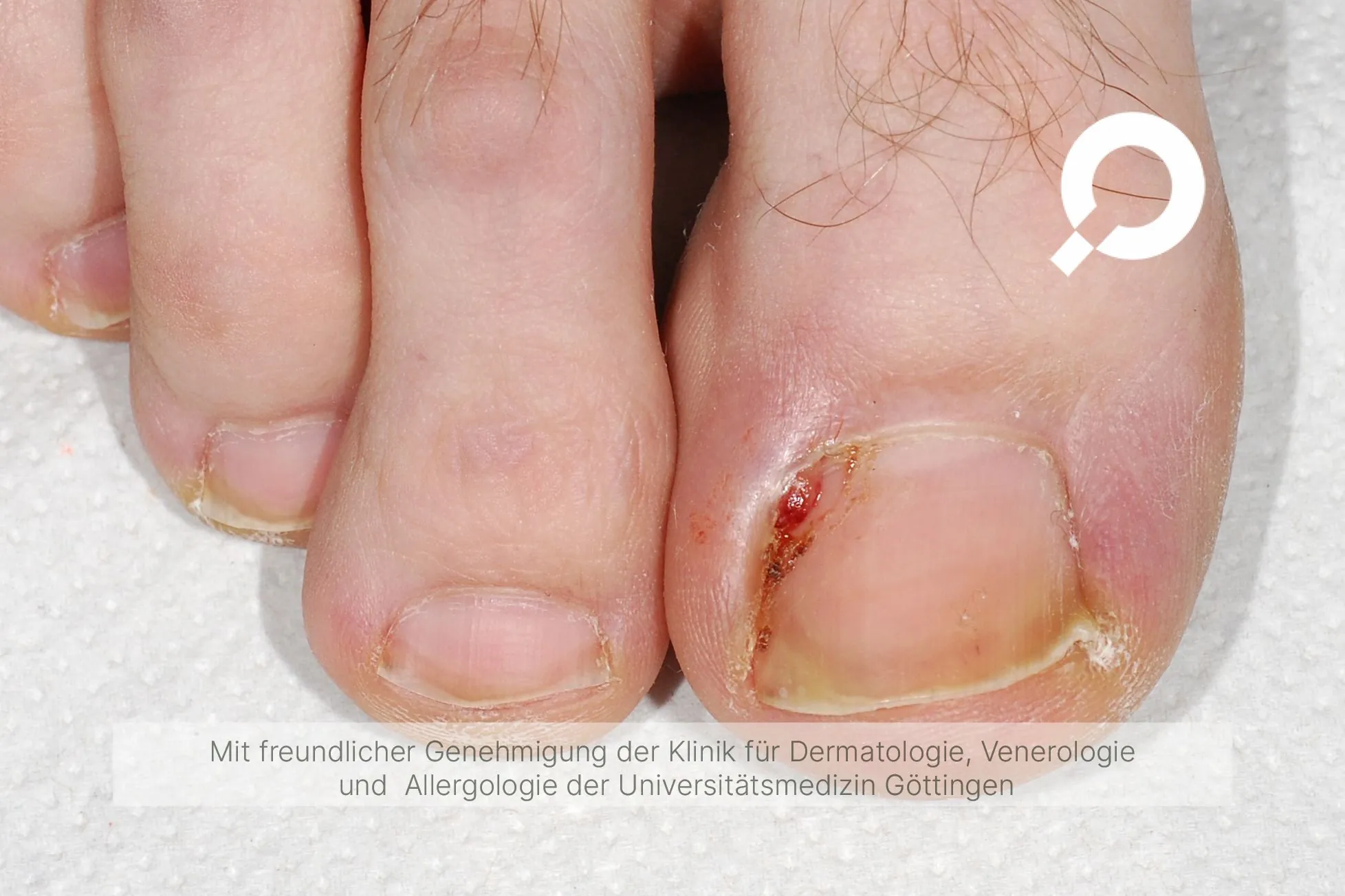 Beispielbild Symptome eingewachsener Zehnagel