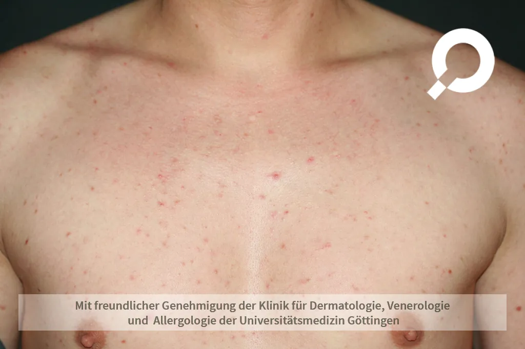 Rote Punkte auf der Brust