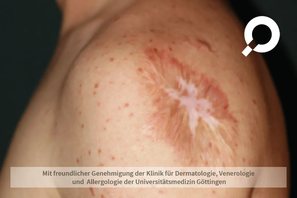 Beispielbild Symptome Urtikaria pigmentosa