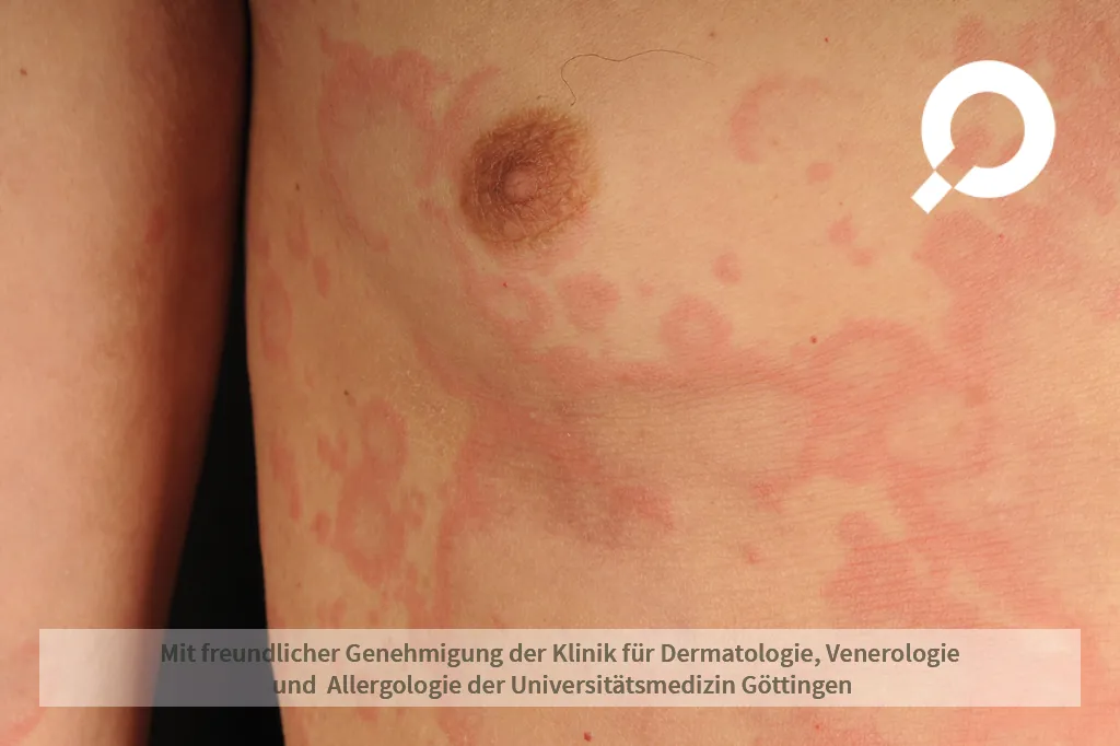 Nesselsucht unter der Brust