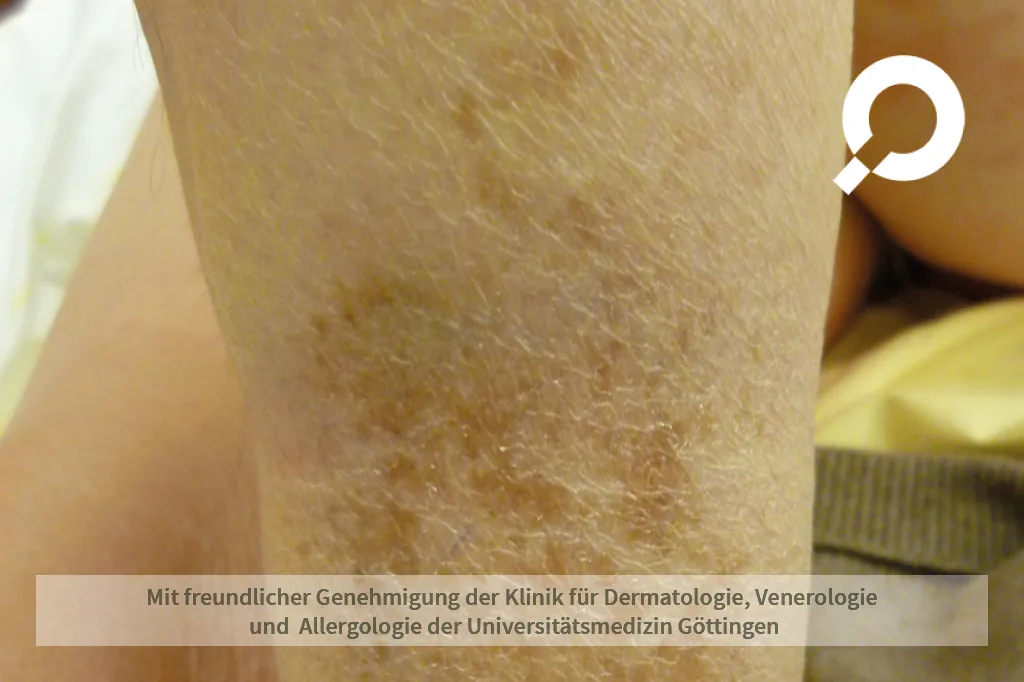Trockene Stelle am Arm