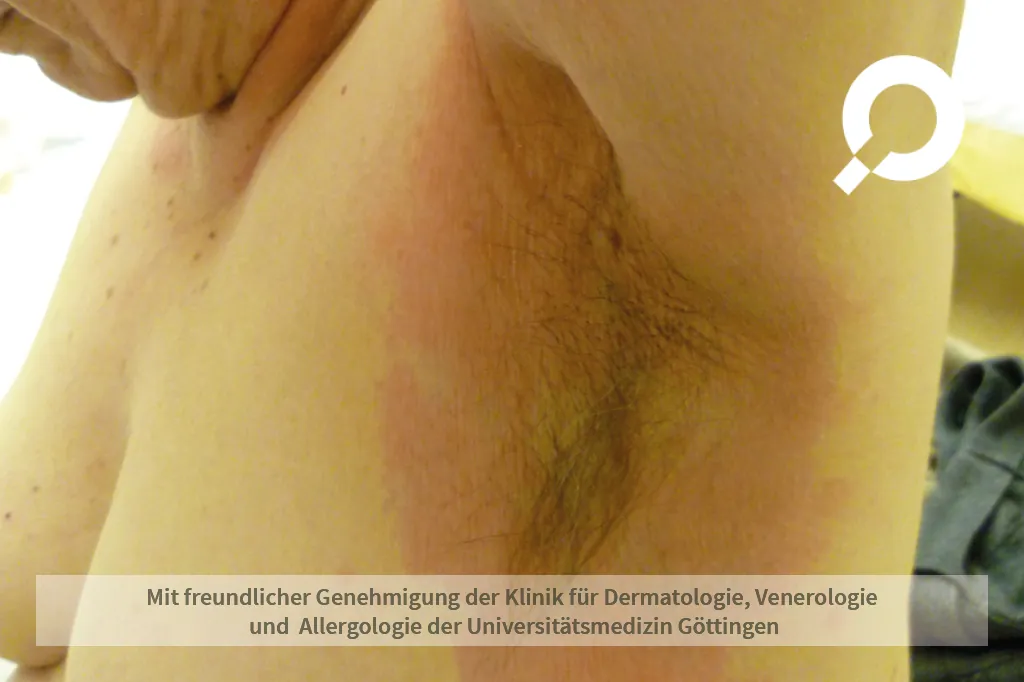 Rötung unter der Achsel