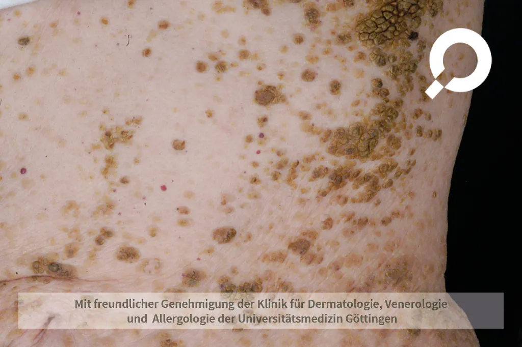braune Warzen auf der Haut