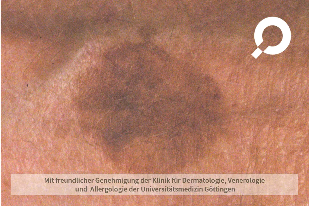 dunkel brauner Fleck auf der Haut