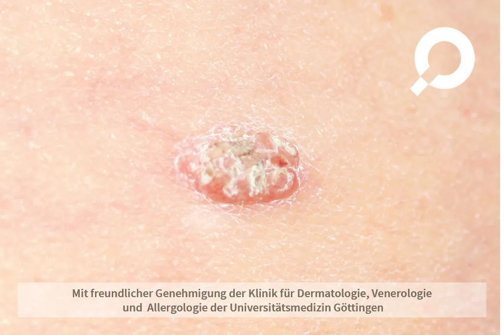 Warze auf der Haut