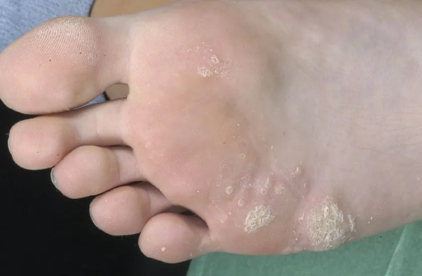 Knötchen an Fußsohle