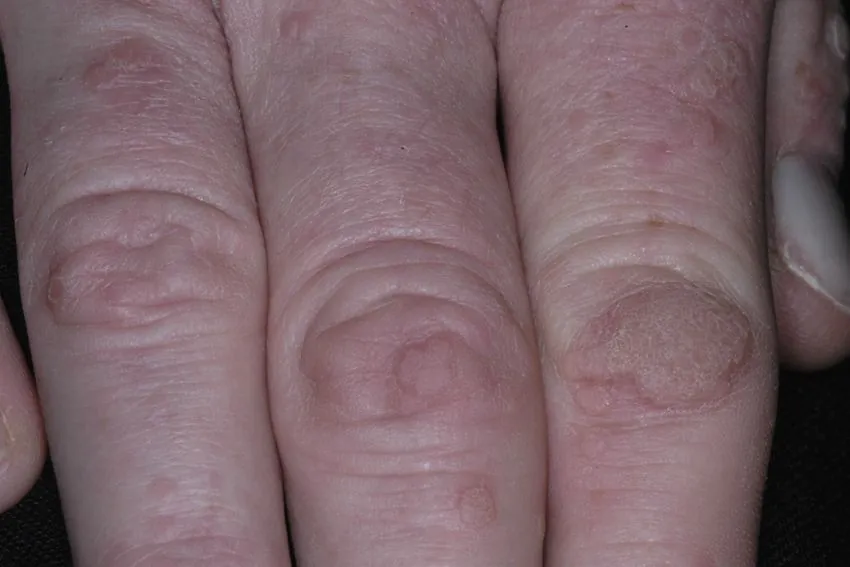 Warzen an den Fingern