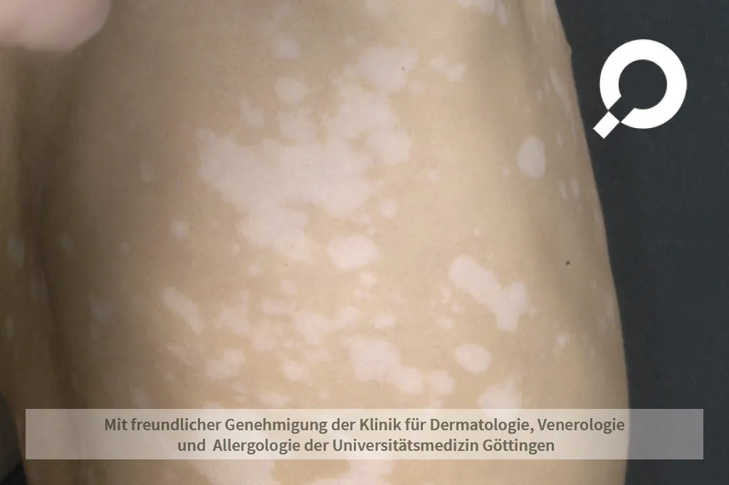 Beispielbild Symptome Vitiligo