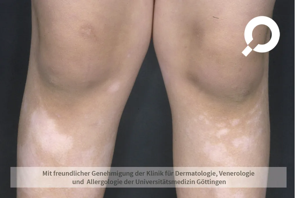 Weiße Flecken an den Beinen