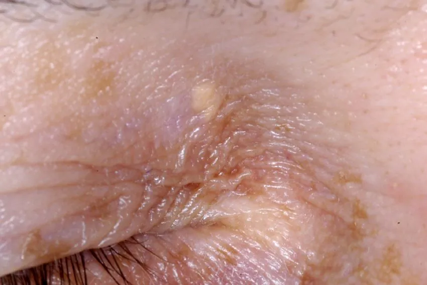 gelbliche Knötchen Augenwinkel