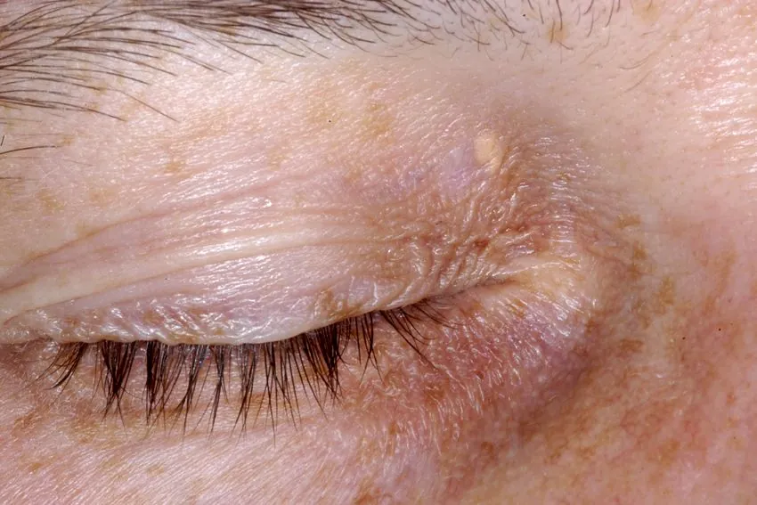 gelbliche Knötchen Augenwinken