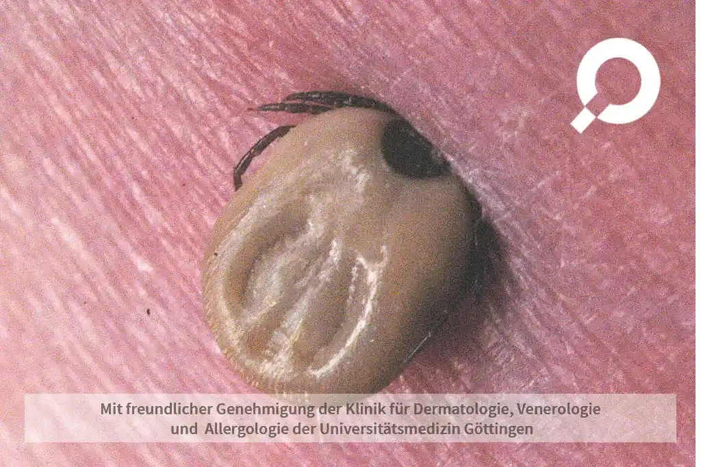 Zecke dringt in die Haut ein