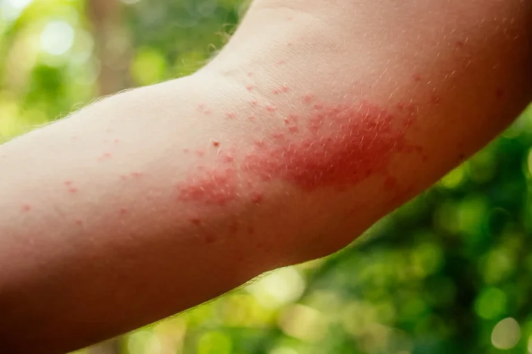 arm mit ausschlag mit Raupendermatitis, Eichenprozessionsspiner Hautreaktion