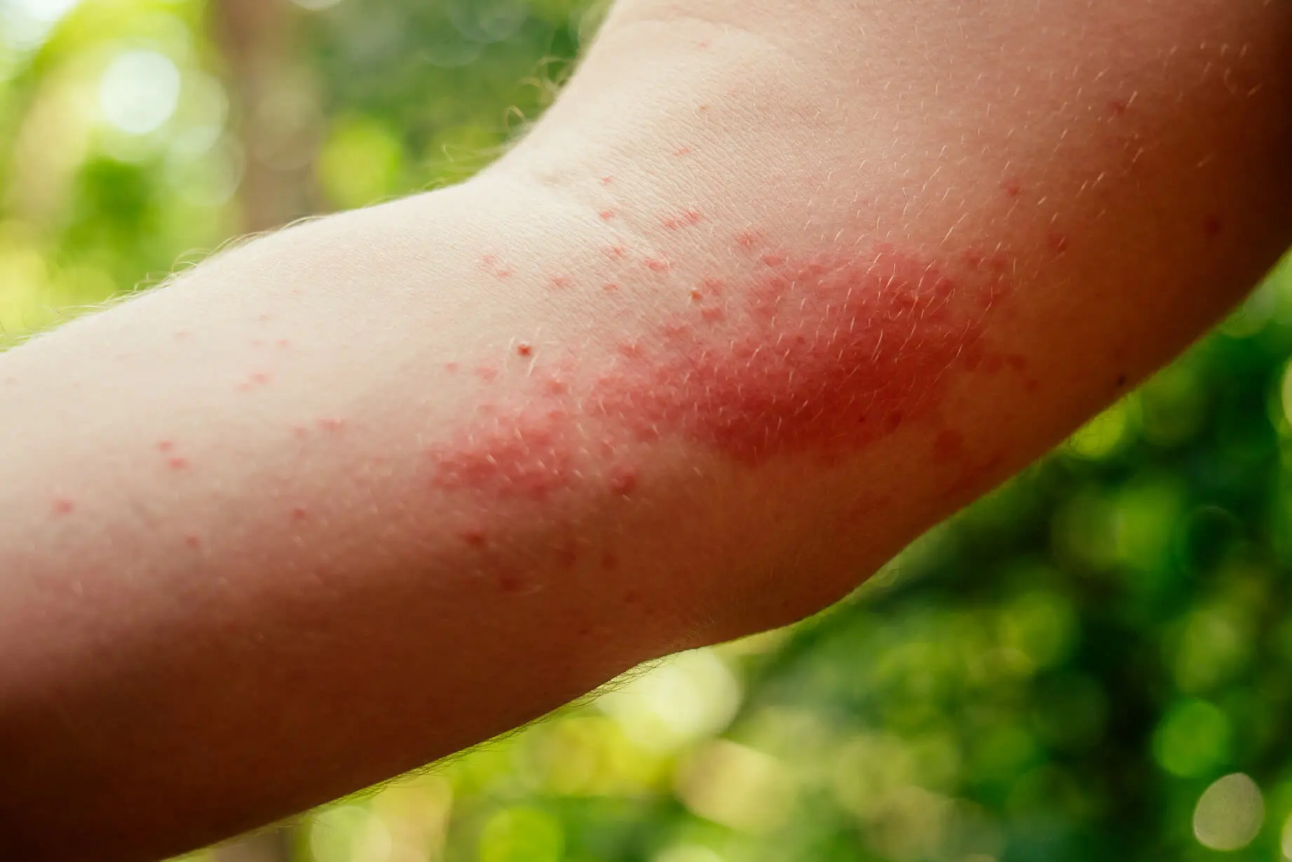 arm mit ausschlag mit Raupendermatitis, Eichenprozessionsspiner Hautreaktion